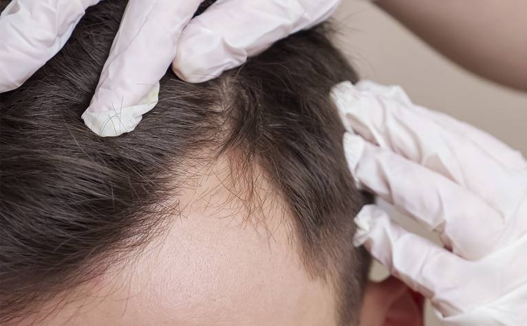 img-exosomas-capilar-02