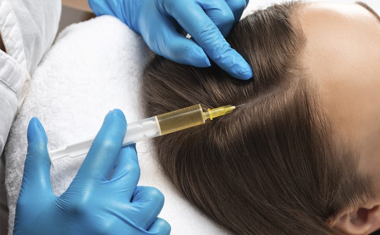 mesoterapia-capilar-01